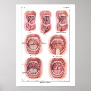 Doenças do francês do poster da anatomia da boca