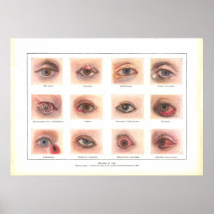 Doenças do francês do poster da anatomia do olho