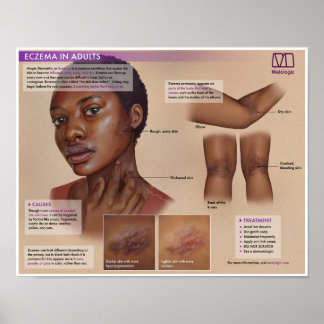 Eczema Melalógico Poster