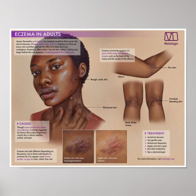 Eczema Melalógico Poster (Frente)