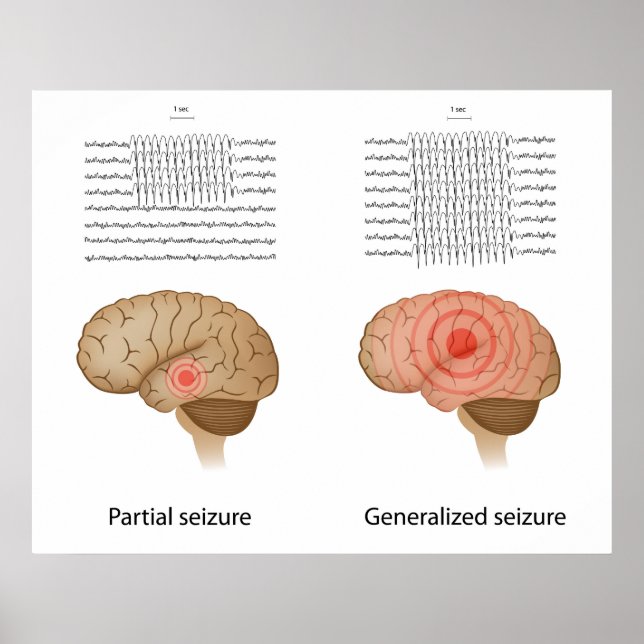 EEG em Poster de epilepsia parcial e generalizada (Frente)