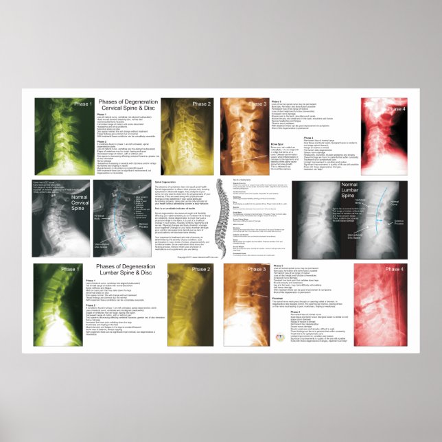 Fases Cervical Lumbar Spinal Poster (Frente)