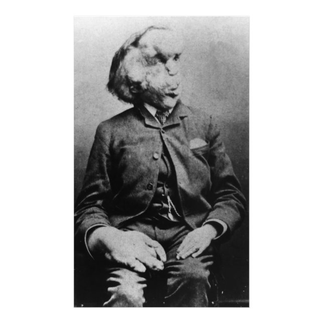 Foto Joseph "John" Merrick O Homem Elefante de 1889 (Frente)