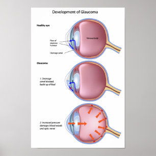 Glaucoma Poster
