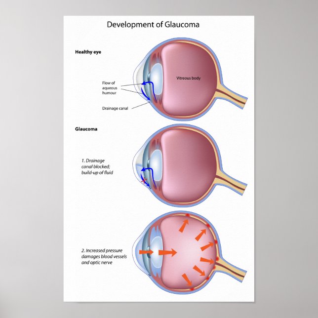Glaucoma Poster (Frente)
