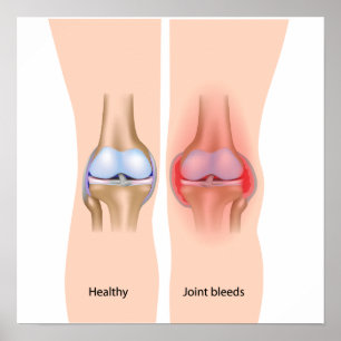 Hemorragias articulares na hemofilia Poster