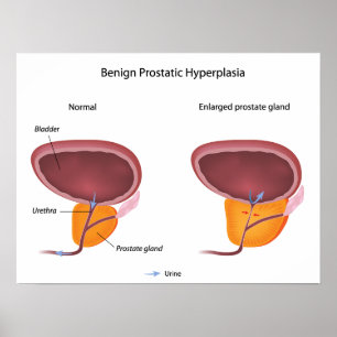 Hiperplasia prostática benigna Poster