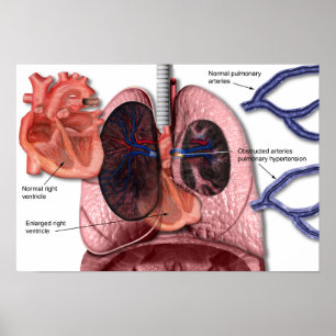 Hipertensão pulmonar poster