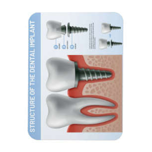 Íman Estrutura do implante dentário
