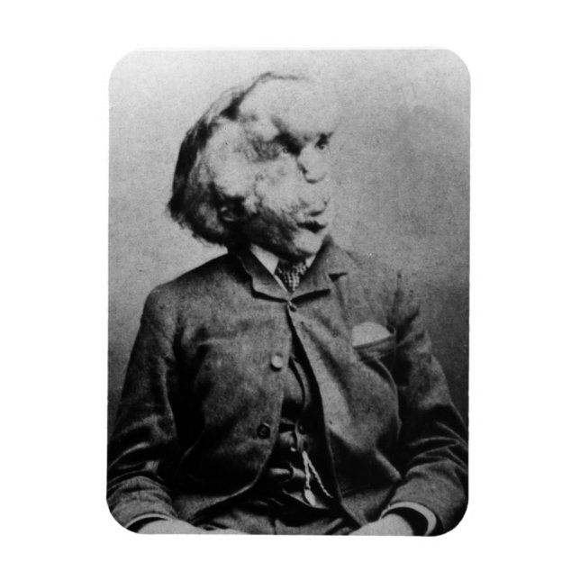 Íman Joseph "John" Merrick O Homem Elefante de 1889 (Vertical)