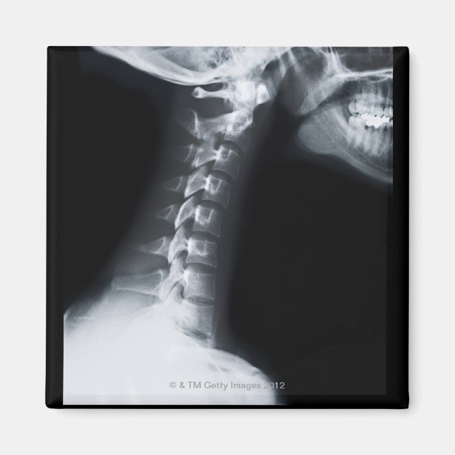 Íman raio X das vértebras do pescoço, incluindo a mandí (Frente)