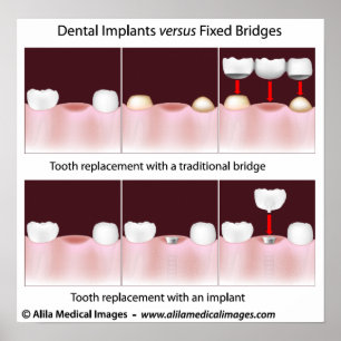 Implante dental contra o poster da ponte