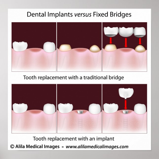 Implante dentário versus Poster de ponte (Frente)
