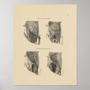 Impressão da anatomia 1880 da hérnia do vintage