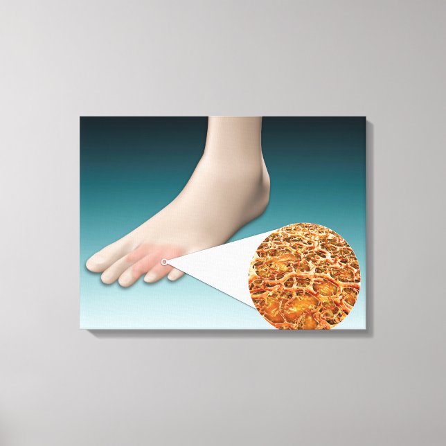 Impressão Em Tela Anatomia Do Fungo Pé Com Fechamento Microscópico (Frente)