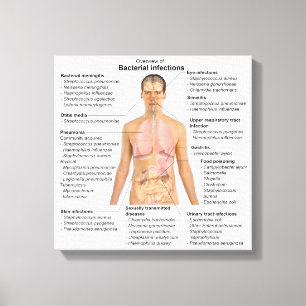 Impressão Em Tela Gráfico de infecções bacterianas em seres human
