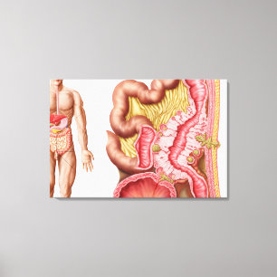 Impressão Em Tela Ilustração Da Diverticulose No Colão