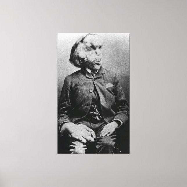 Impressão Em Tela Joseph "John" Merrick O Homem Elefante de 1889 (Frente)