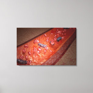 Impressão Em Tela Rendição microscópica de uma infecção do sang