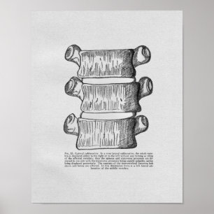 Impressão vertebral do vintage do Subluxation da