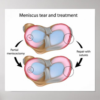 Lágrimas de menisco e Poster de cirurgia
