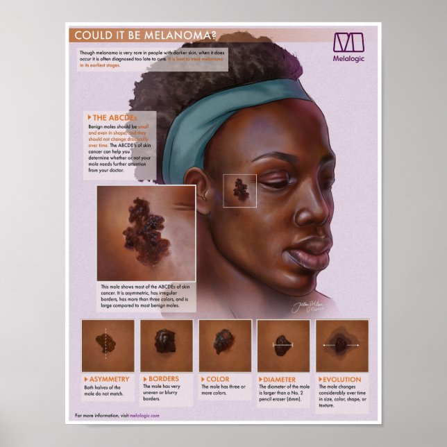 Melalogia Melanoma Poster (Frente)