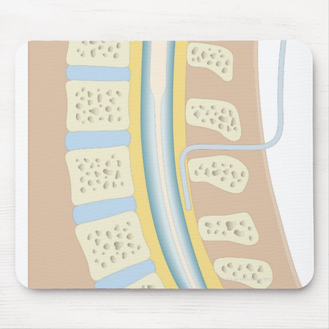 Mousepad Anestesia Epidural (Frente)