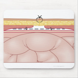 Mousepad Ilustração de uma Hérnia