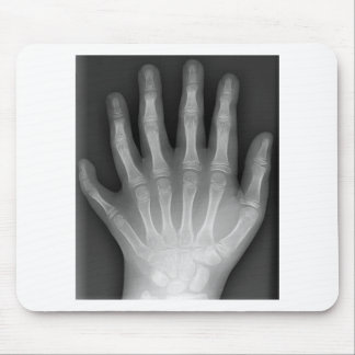 Mousepad Polydactyly, seis mãos apontado, raio X, raridade!