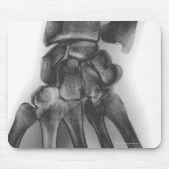 Mousepad Pulso normal, raio-X (Frente)