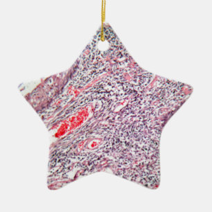 Ornamento De Cerâmica Pilhas do tecido de uma cerviz humana com cancer