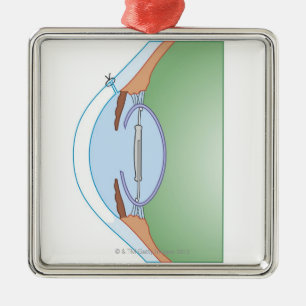 Ornamento De Metal Cirurgia da catarata