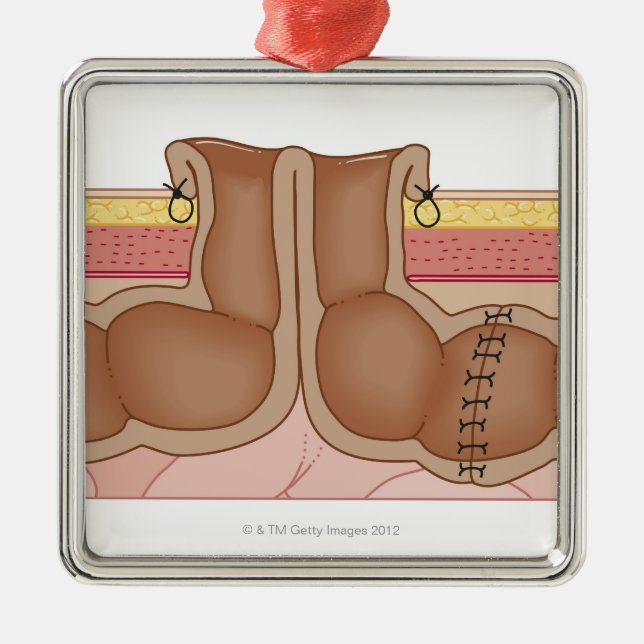 Ornamento De Metal Colostomia provisória (Frente)