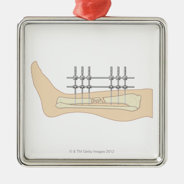Ornamento De Metal Fixator externo (Frente)