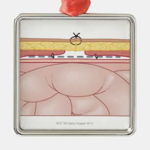 Ornamento De Metal Ilustração de uma hérnia