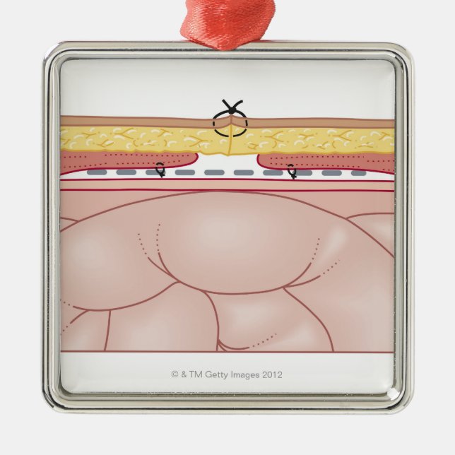 Ornamento De Metal Ilustração de uma hérnia (Frente)