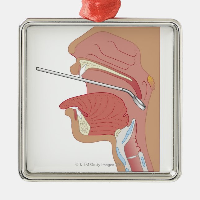 Ornamento De Metal Laringoscopia do espelho (Frente)