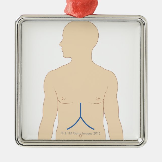 Ornamento De Metal Transplantação do fígado (Frente)