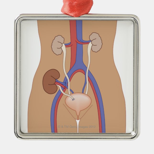 Ornamento De Metal Transplantação do rim (Frente)