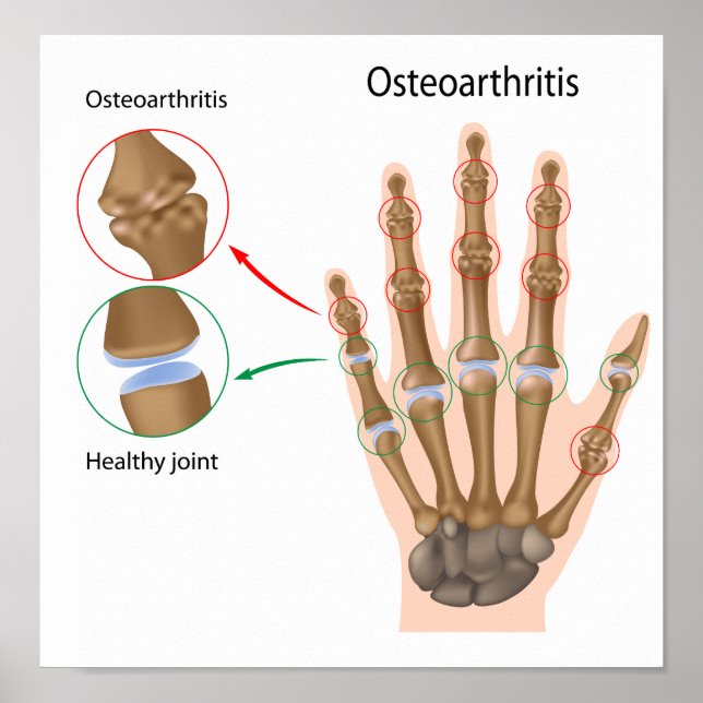Osteoartrite da mão Poster (Frente)