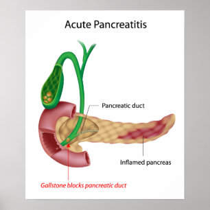 Pancreatite aguda Poster