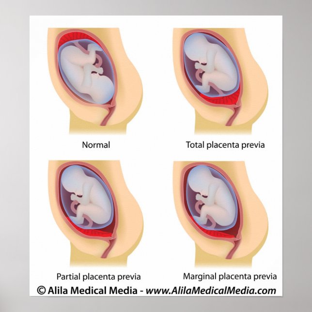 Placenta - poster prévia (Frente)