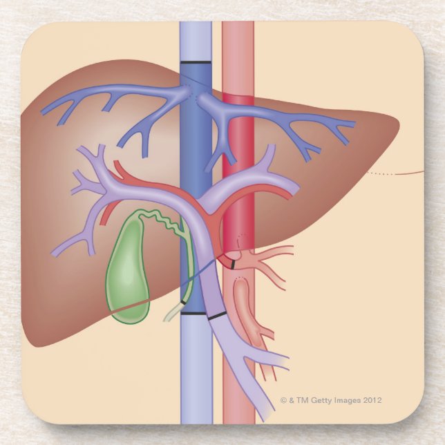 Porta-copo Procedimento da transplantação do fígado (Frente)