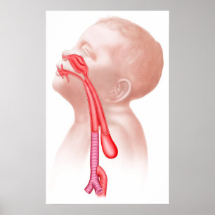 Póster Anatomia de uma fístula Tracheoesophageal