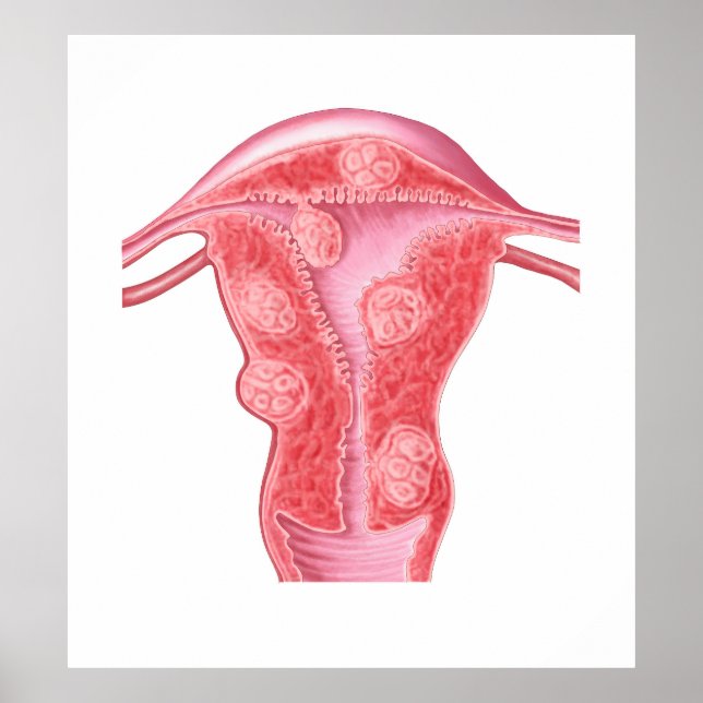 Póster Anatomia Dos Tumores Fibroides No Útero Feminino (Frente)