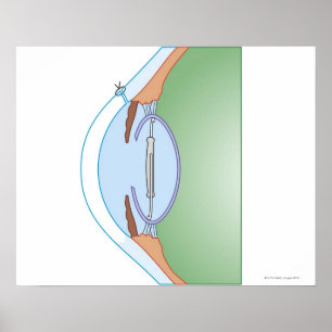 Póster Cirurgia da catarata