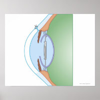 Cirurgia de cataratas