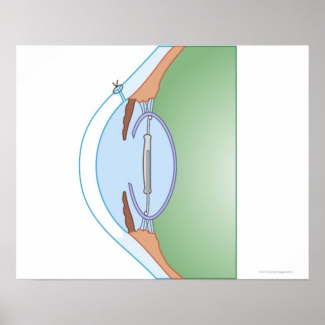 Póster Cirurgia de cataratas (Frente)