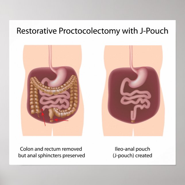 Póster Cirurgia de proctocolectomia reativa com j-pouch (Frente)