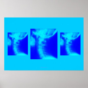 Poster da quiroterapia: Azuis cervicais laterais